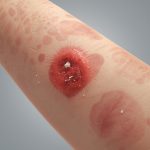 Dermatitis